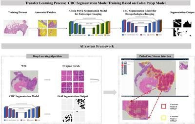 Development and external validation of a transfer learning-based system for the pathological diagnosis of colorectal cancer: a large emulated prospective study